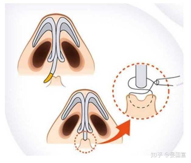 鼻子歪怎么办 知乎
