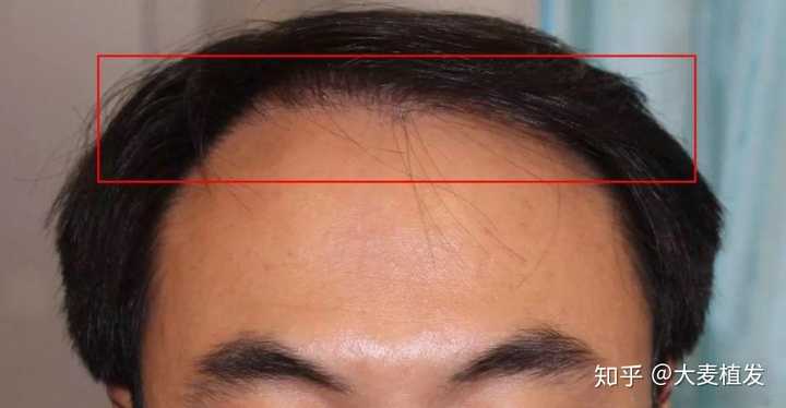 19岁头发秃了怎么办?