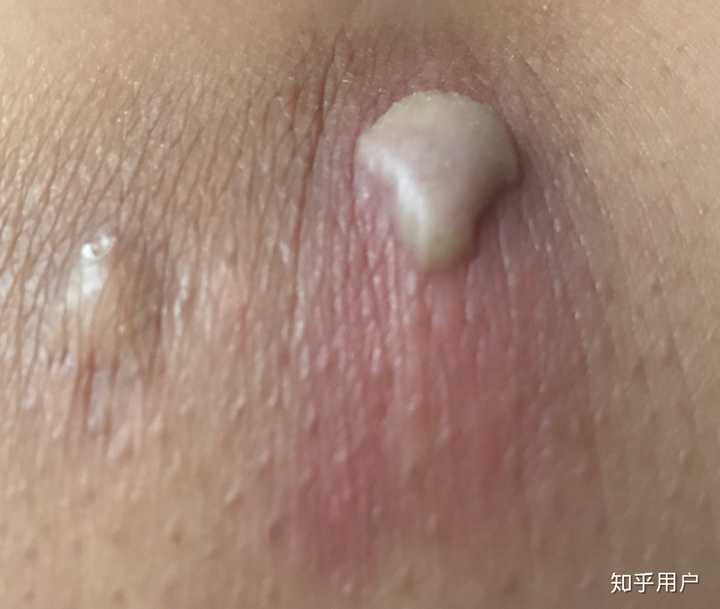请问皮脂腺囊肿可以拖多久，在屁股尖上，直径一厘米左右，两年前就发现了?