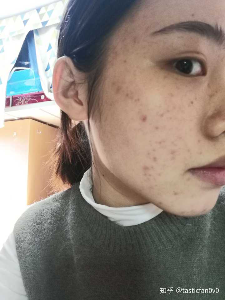 脸上有痘痘,痘印的女孩能找到男朋友吗?