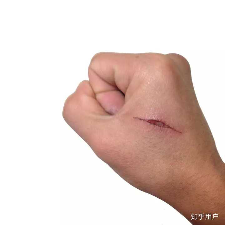 真的有疤痕体质这个东西吗? - 知乎