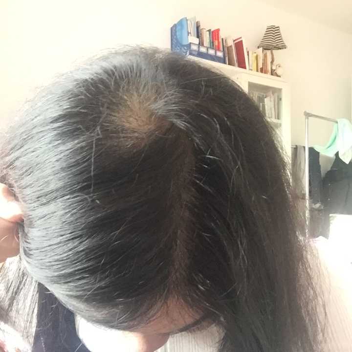 女生,脱发,有一块头皮都开始秃了,怎么办?有图?