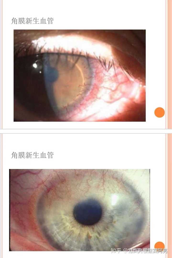 人大代表不建议年轻人戴美瞳眼镜 戴美瞳会对眼睛有伤害吗 如何减轻伤害 知乎