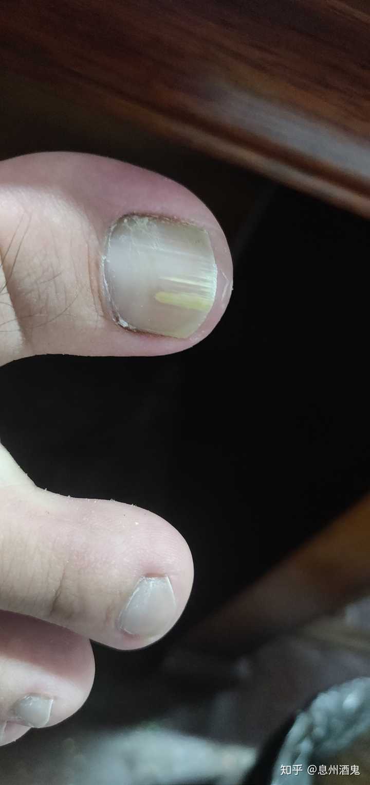 脚指甲条状发白之前只有一条现在旁边又出现一条细的