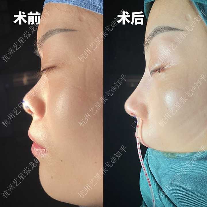 塌鼻梁应该怎样矫正？ - 知乎