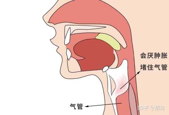 会厌炎有哪些症状表现? - 知乎