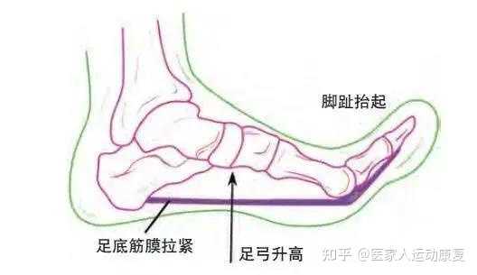 足底筋膜炎能痊愈吗 知乎