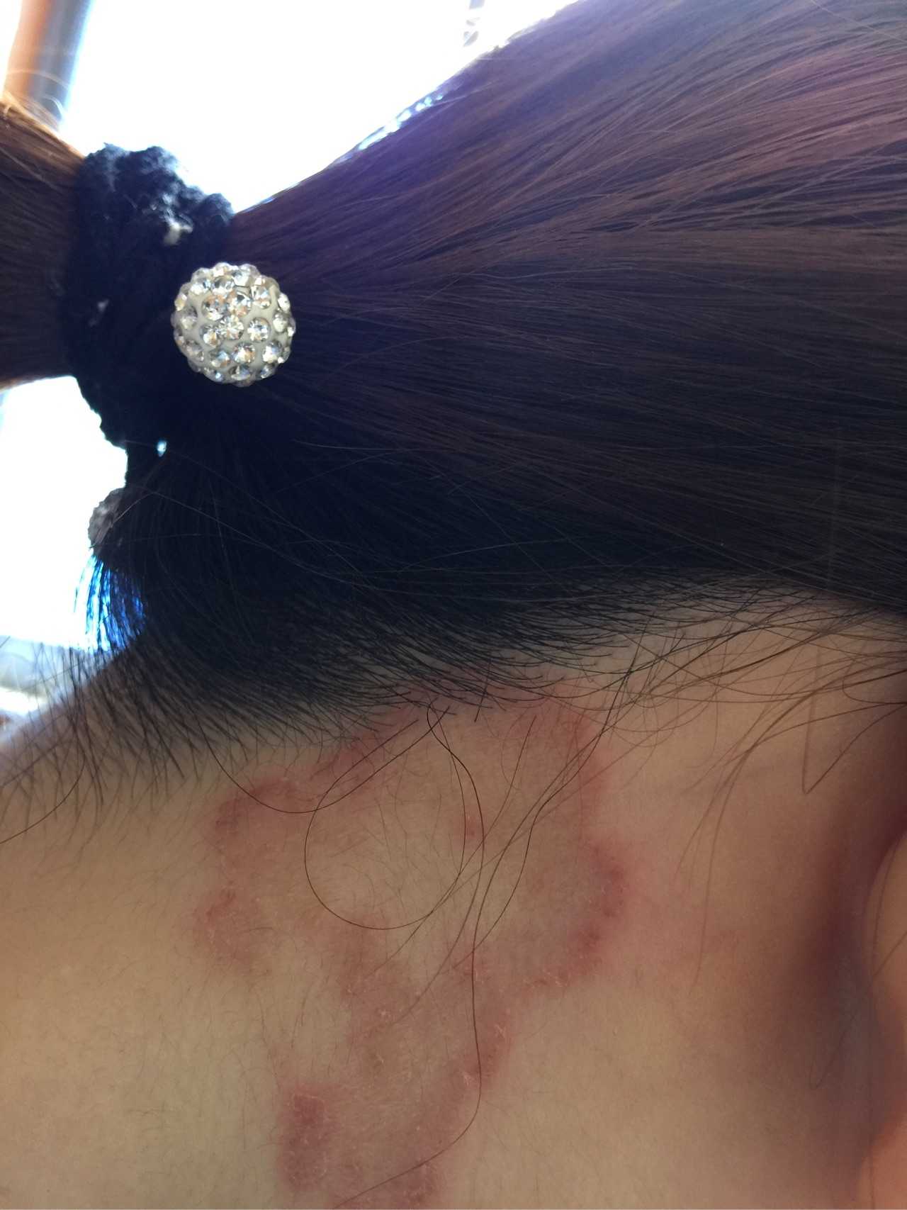 得猫藓很久了,之前还扩散过,主要原因是由于去医院医生给我开的药