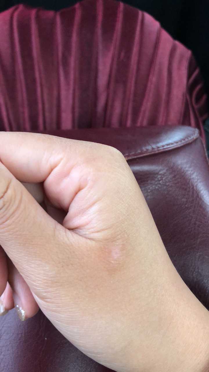 疤痕体质,被蚊虫叮咬或者破皮就会留疤怎么办?