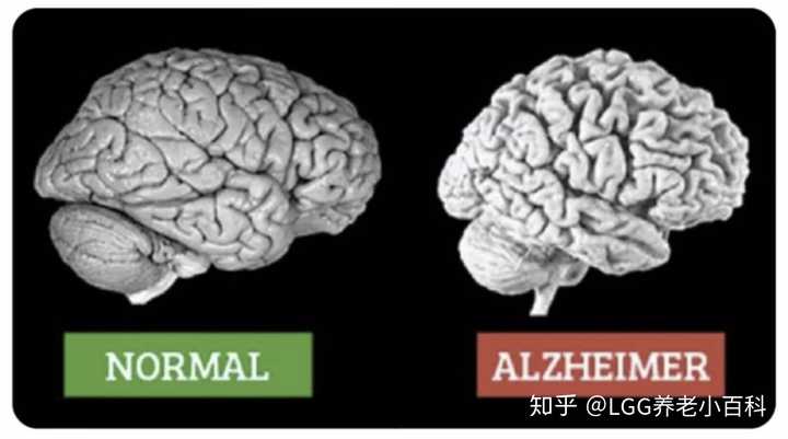 左侧为正常的衰老型大脑 右侧为阿兹海默症大脑