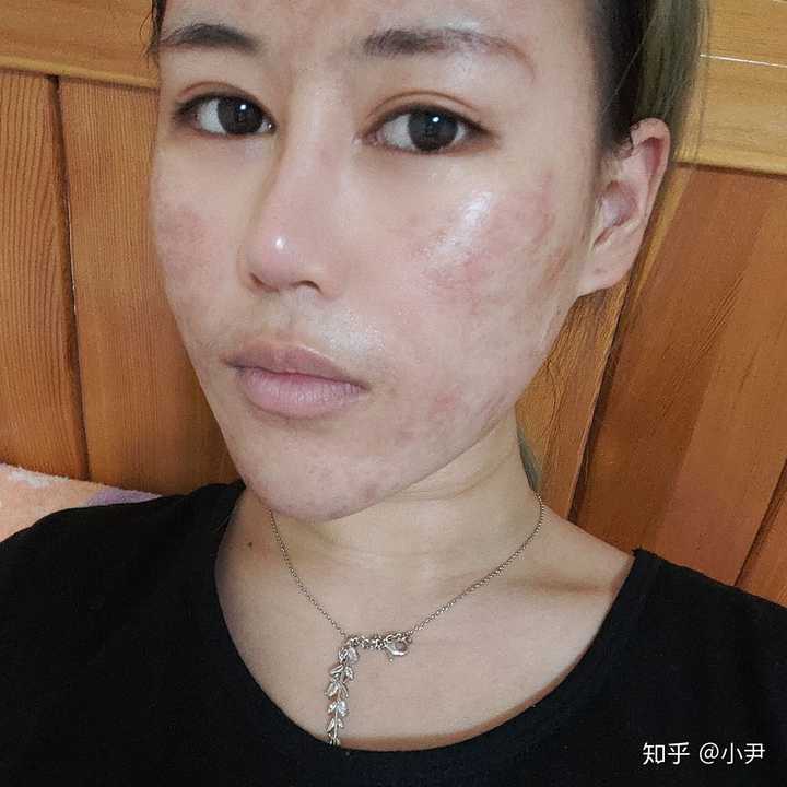 男生是不是不會喜歡臉上有痘印或痘痘的女孩子啊?