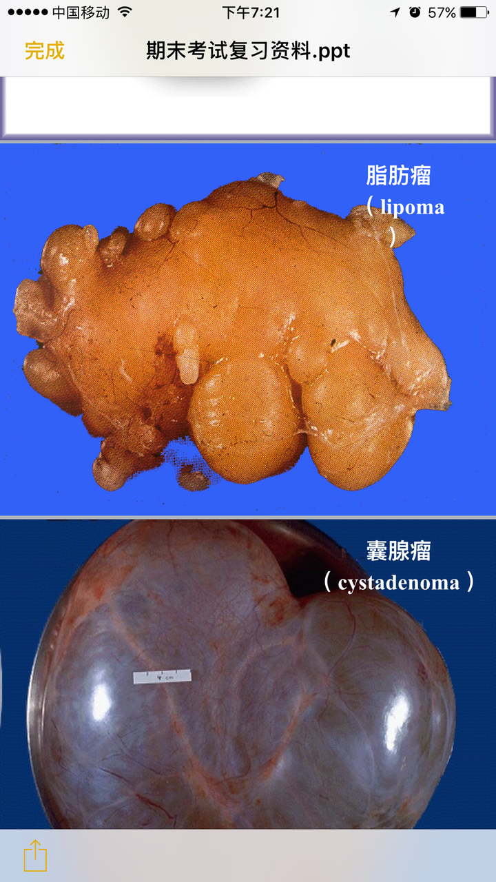 脂肪瘤内部图片