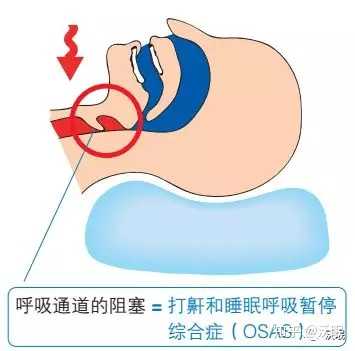 止鼾器是否真的管用 那一种类型的止鼾器管用呢 知乎