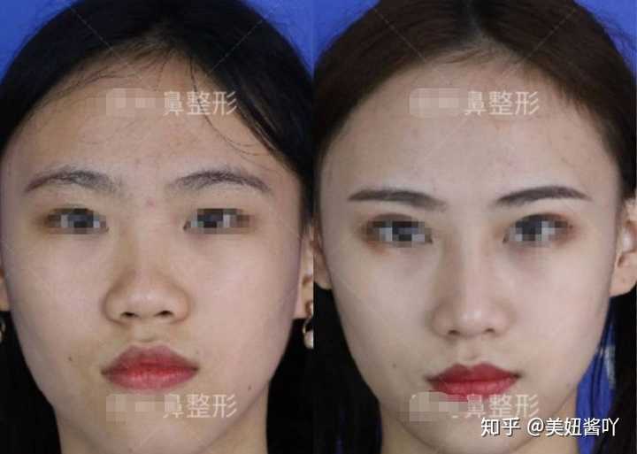 隆鼻老了以后会怎么样 知乎 隆鼻老了以后会怎么样 知乎