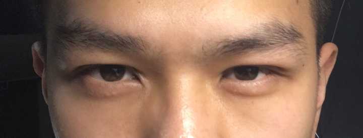 双眼皮的价格_郑大一附院割双眼皮价格_全切双眼皮价格