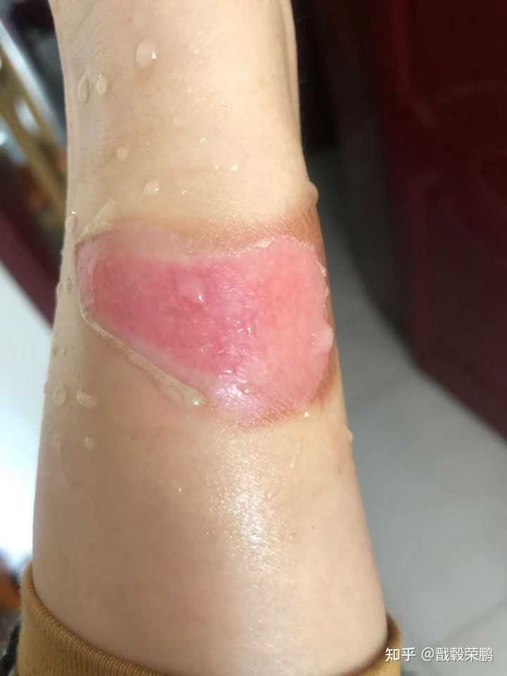 被开水烫到 是否需要第一时间用自来水冲洗 知乎 被开水烫到 是否需要第一时间用自来水冲洗 知乎