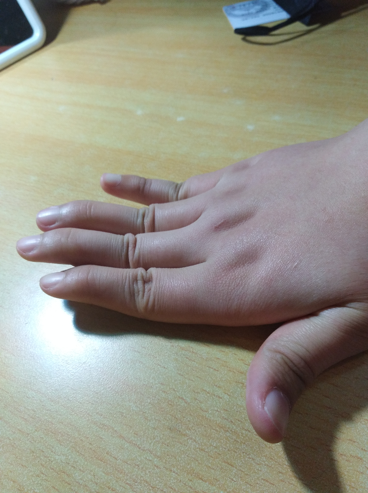 手指弯曲是什么原因造成的?