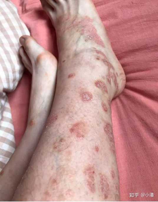 牛皮癣好了以后怎么能防止复发?