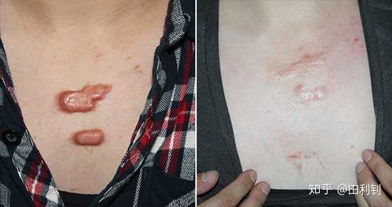 请问这是属于疤痕增生吗?