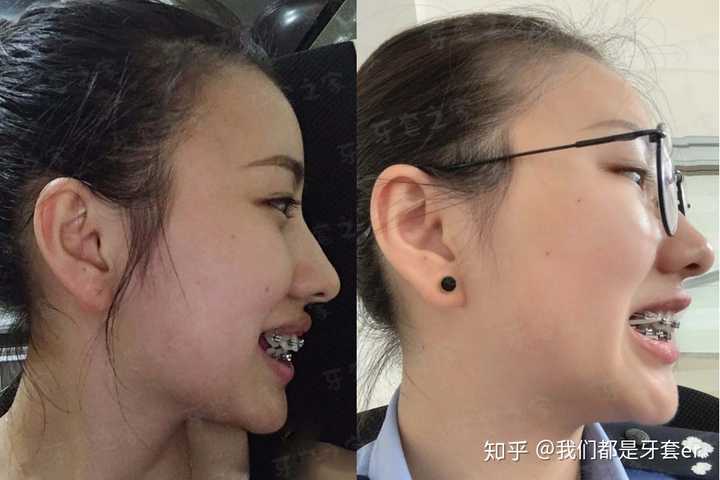 因为牙齿自卑怎么办啊?