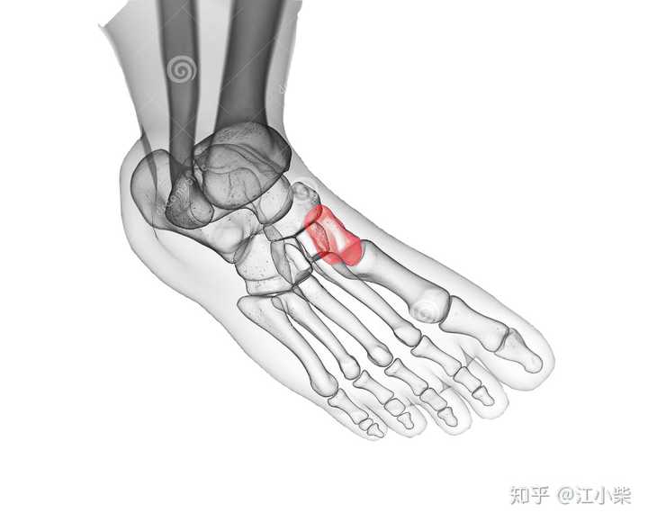 跑步引起脚背痛怎么办 脚背疼可以继续跑步吗 长期跑步脚背疼怎么恢复