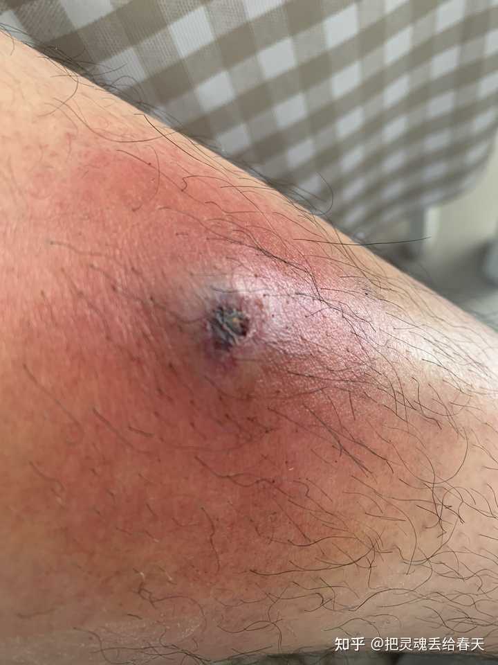 一个火疖子能大到什么地步 知乎