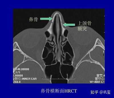 捏鼻梁真的有效吗 知乎