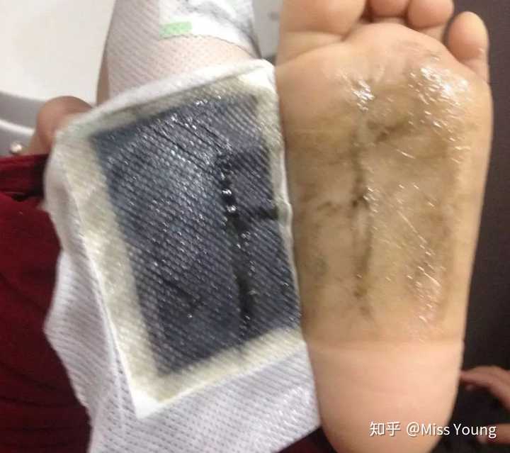 足贴能祛湿排毒 贴足底一晚 早上全是又黑又油的 说是毒气湿气 这个东东到底是不是真的 便宜的5毛一张 贵的要十块一张 我婆婆曾经买了好几万呢 神奇的是 只有贴在穴位上 才会变黑 找不到理由驳斥