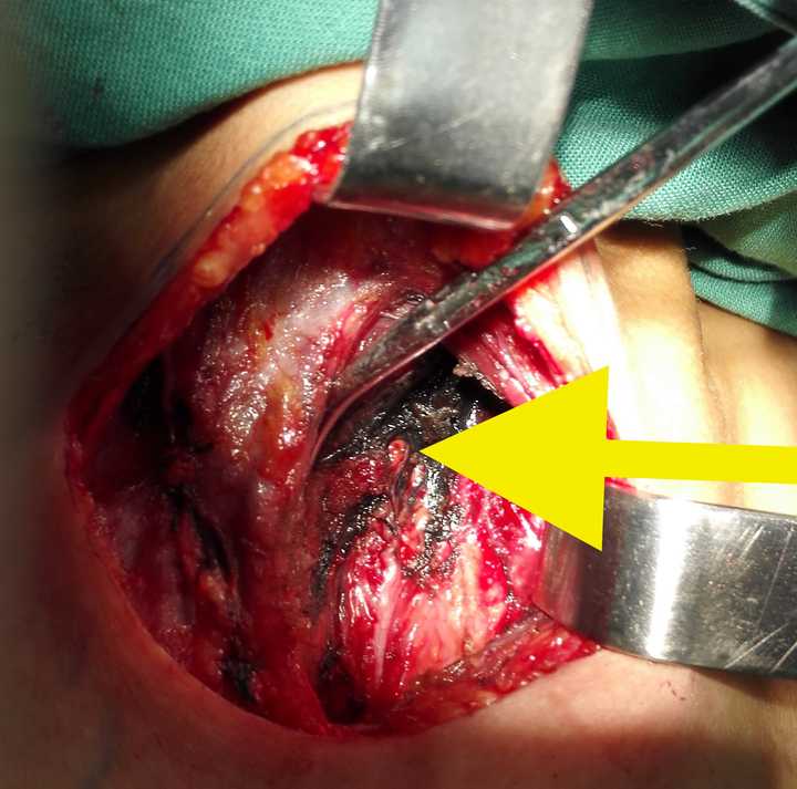 上图可以看到黑染的淋巴结和淋巴管(蓝色箭头)和没有染色的甲状旁腺