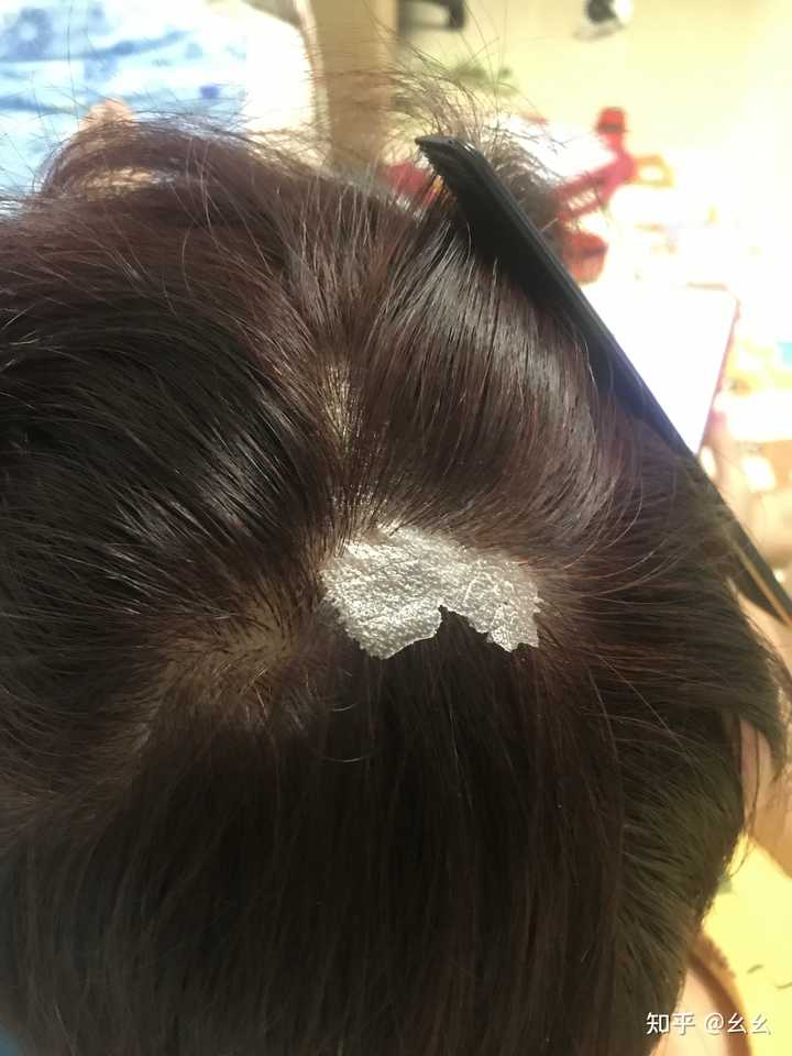 见过的最大头皮屑多大? - 知乎