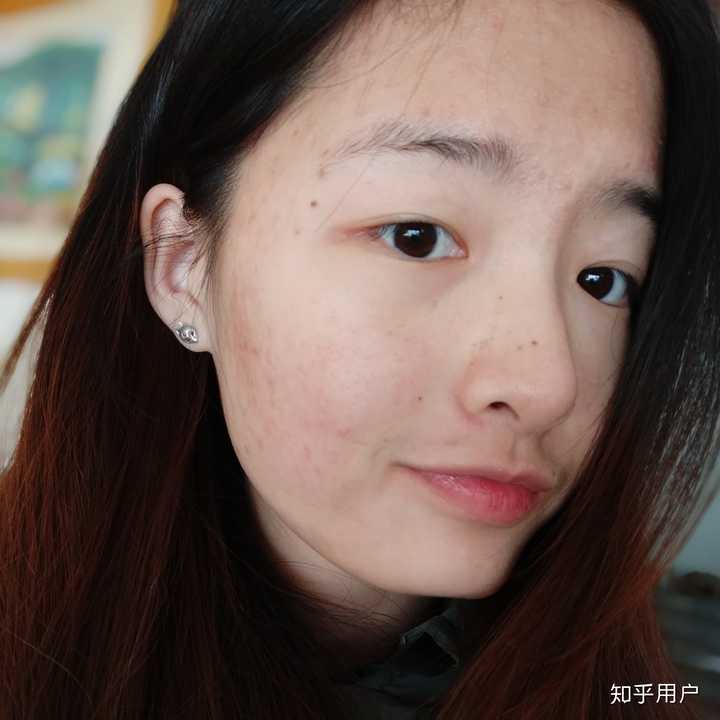 怎麼看待五官漂亮但是皮膚差的女性?