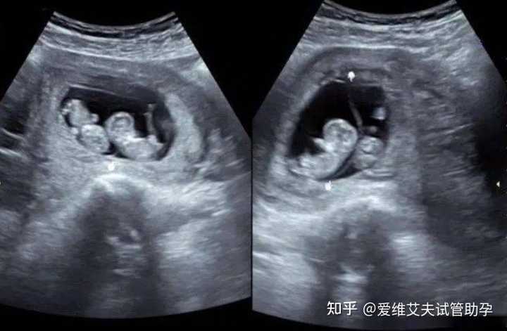 试管婴儿双胞胎费用大约多少? - 知乎