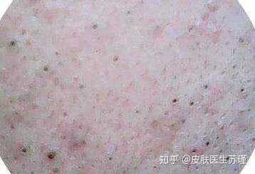 各种皮疹如何区分?例如丘疹、疱疹、荨麻疹、斑疹。 - 知乎