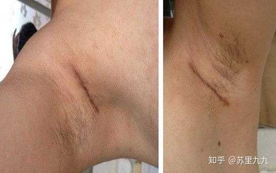 假体隆胸会留疤吗?切口有哪些?