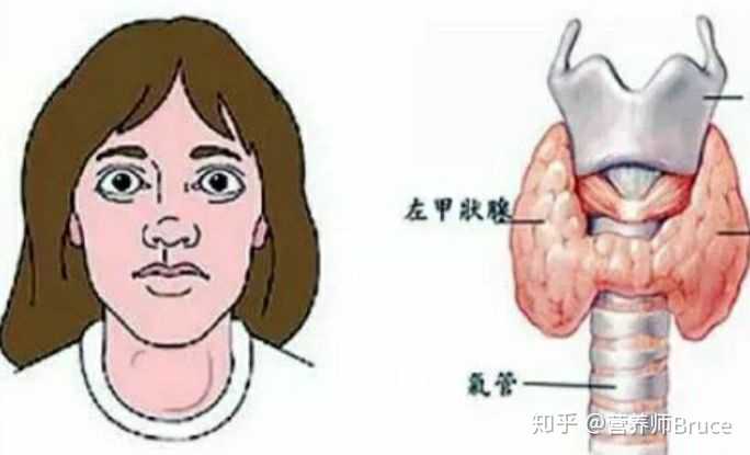 「甲亢」产生的原因是什么，如何预防？
