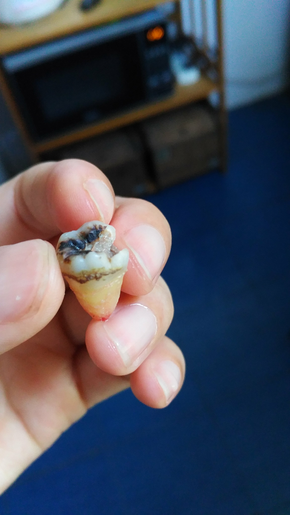 拔智齿有多痛? - 乌贼的回答 - 知乎