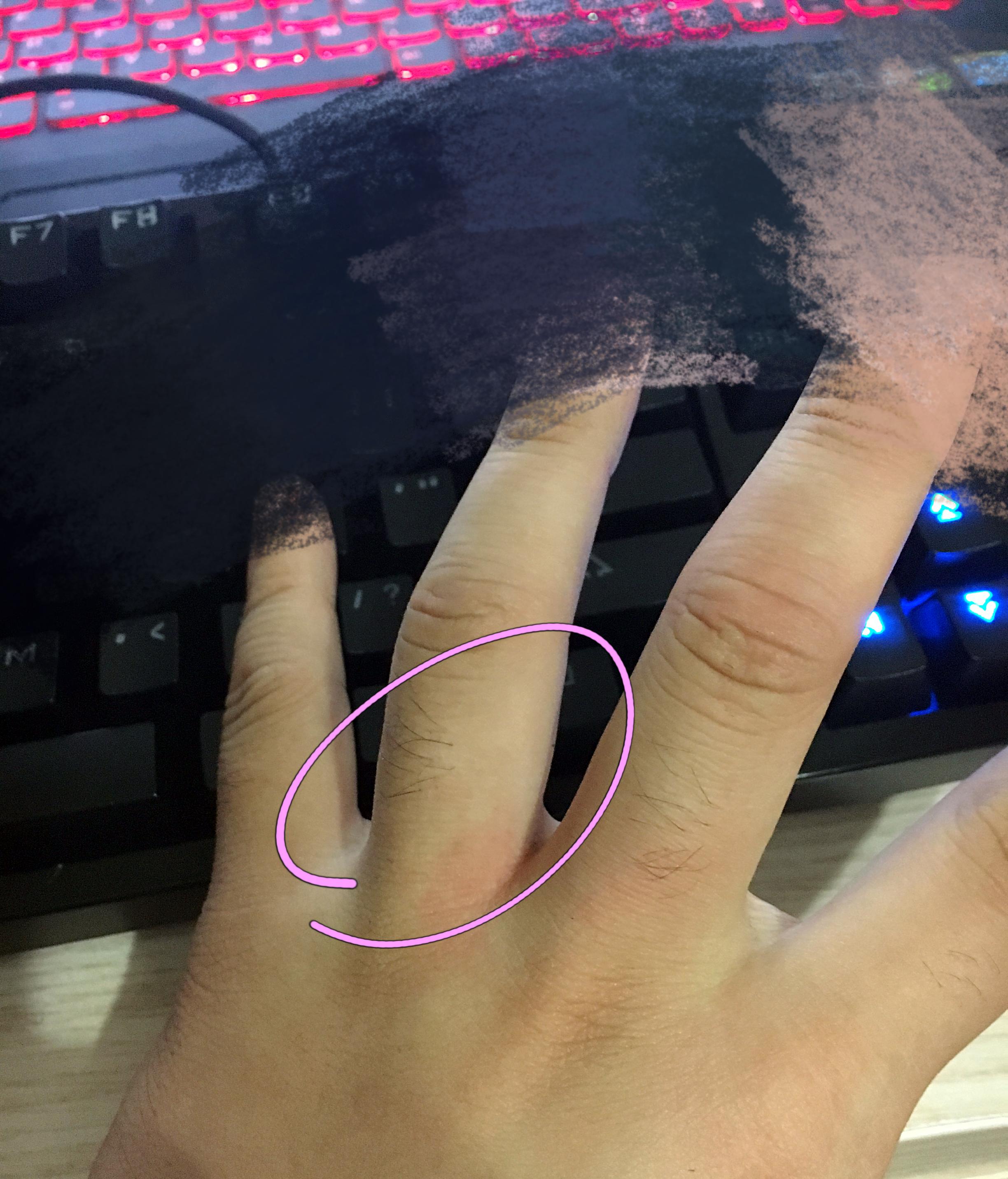 手指关节软组织受伤怎么办?