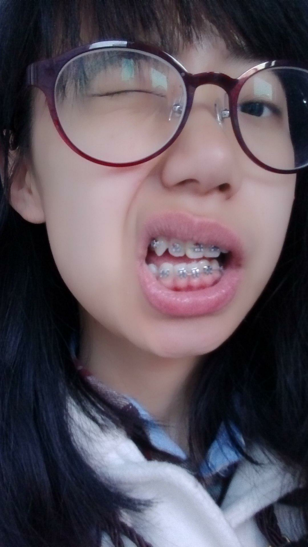 牙不齐(倾斜,拥挤)是怎样的体验?