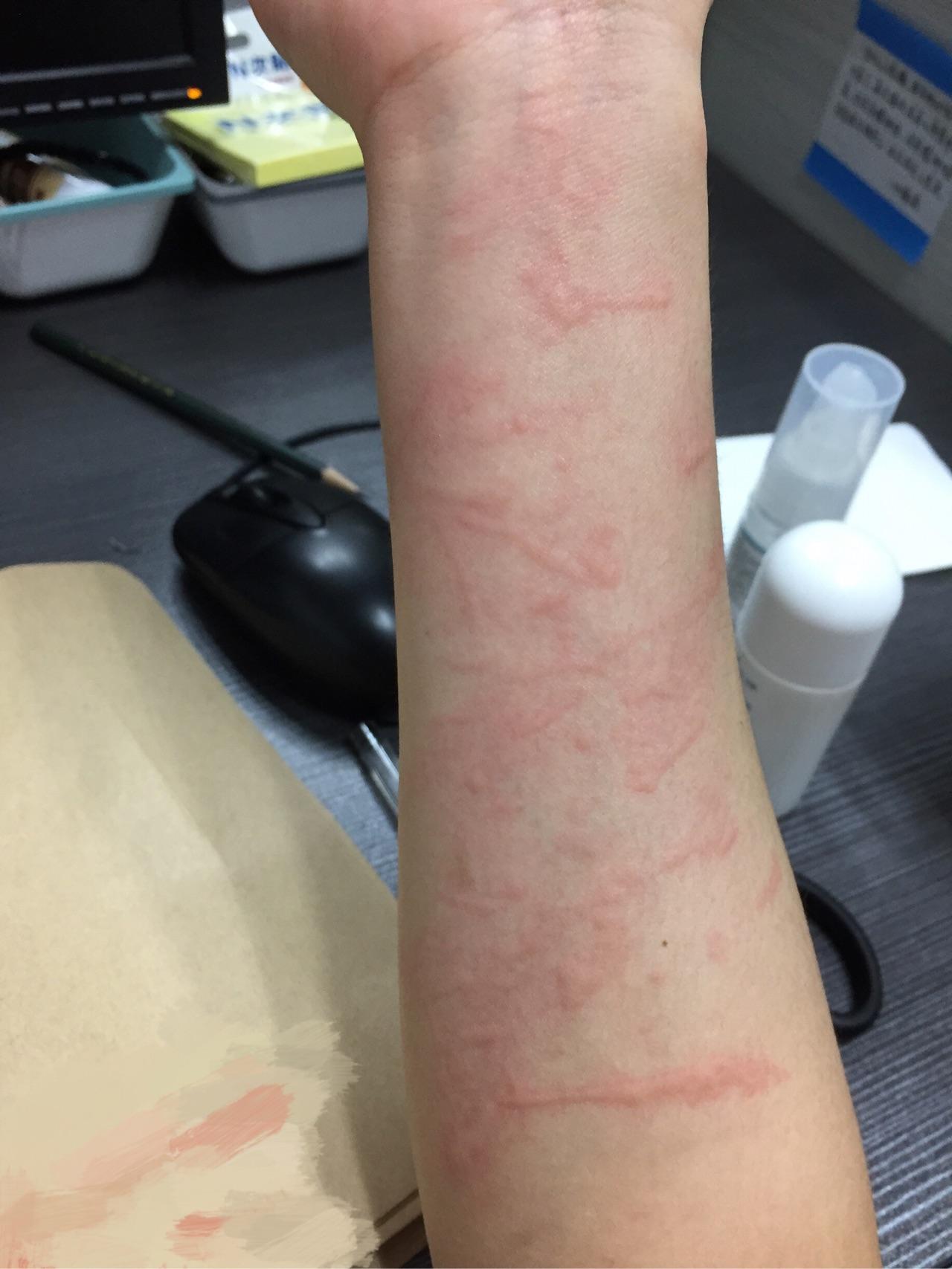 人工荨麻疹皮肤划痕症的原理是什么有治疗的必要么对人的影响大吗