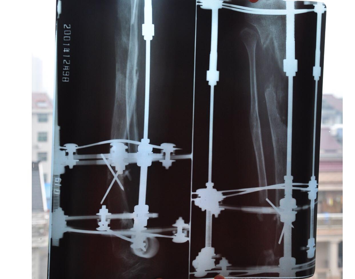 腿骨延长手术可靠吗