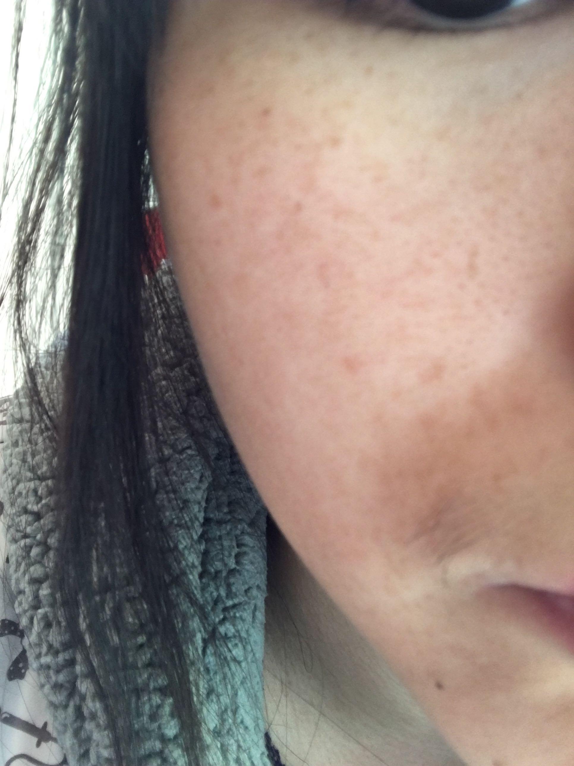 本人21,肤色暗沉,不长痘,两三年前脸上突然长了