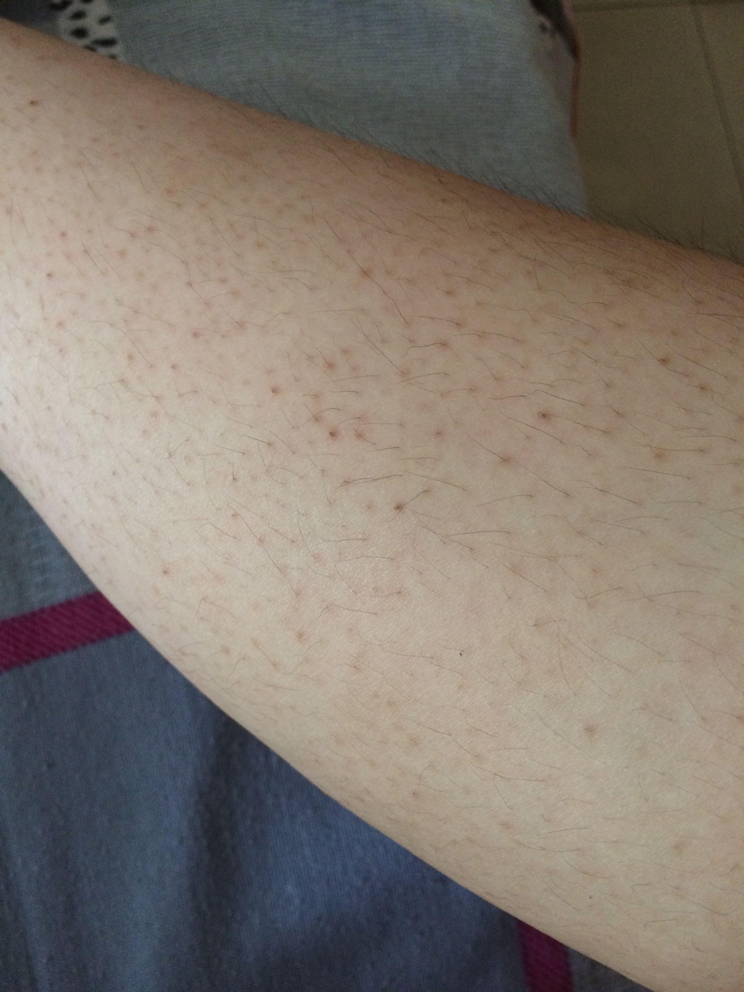 鸡皮肤好了后长出腿毛(为什么腿上突然长了鸡皮肤) 鸡皮肤好了后长出腿毛(为什么腿上突然长了鸡皮肤)