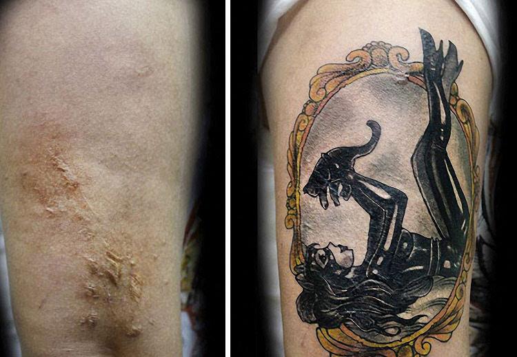 肚子上阑尾刀疤纹什么好?