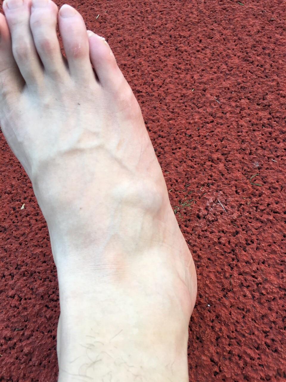 崴一脚骨折的可能性大么? - 知乎