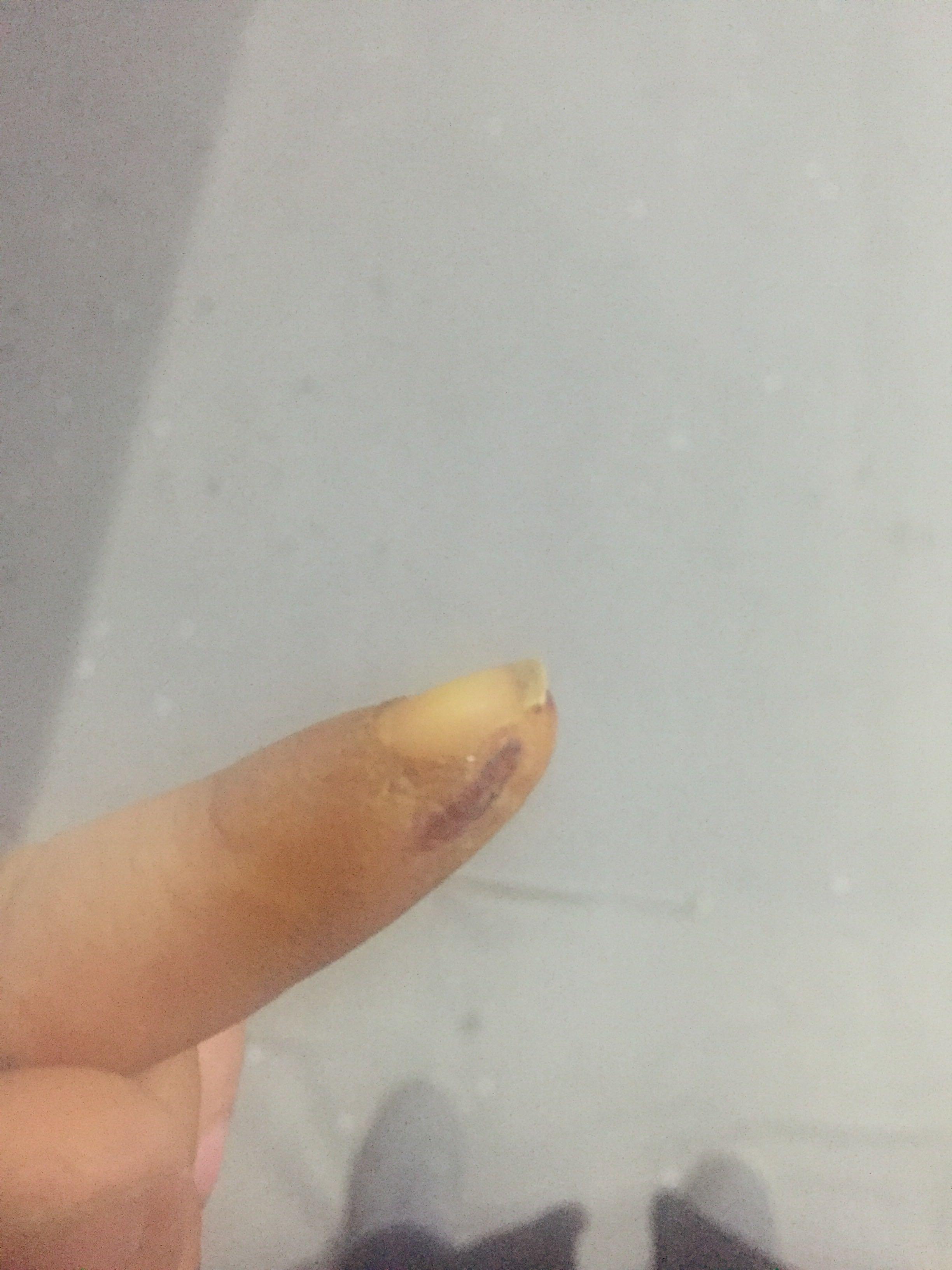 伤口结痂了多久能洗澡? - 李晨曦的回答