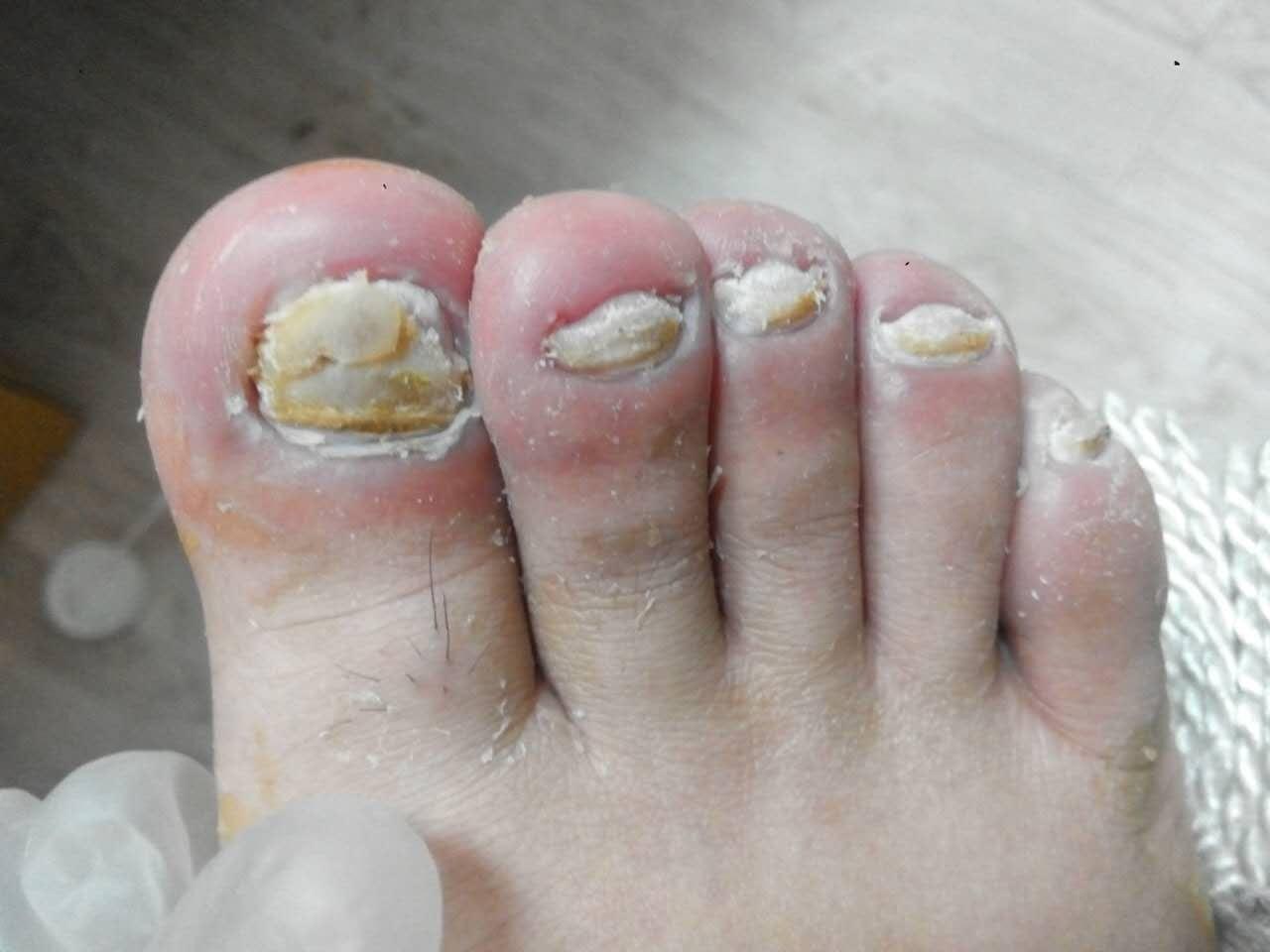 灰指甲治疗四十天了每天用大蒜醋泡脚每天用亮甲隔一天修指甲上药现在