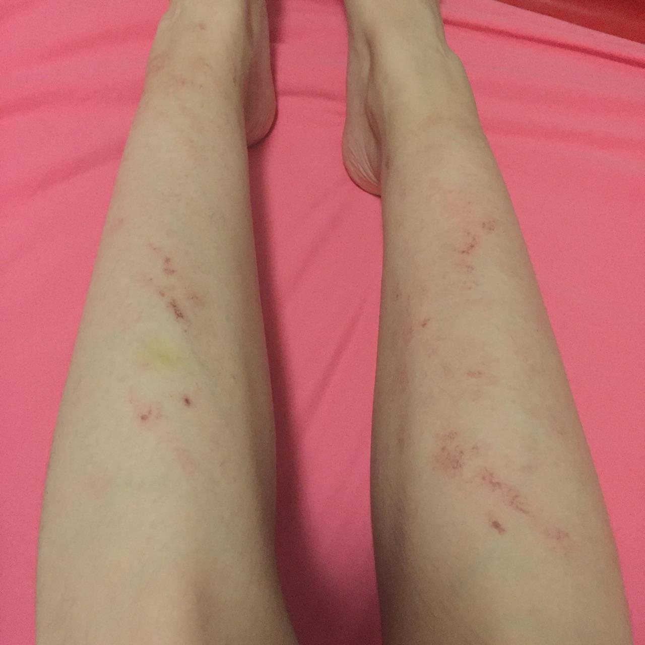 医院激光脱毛后(不是冰点)两三天后结痂了 现在有点红也有点痒 是怎么