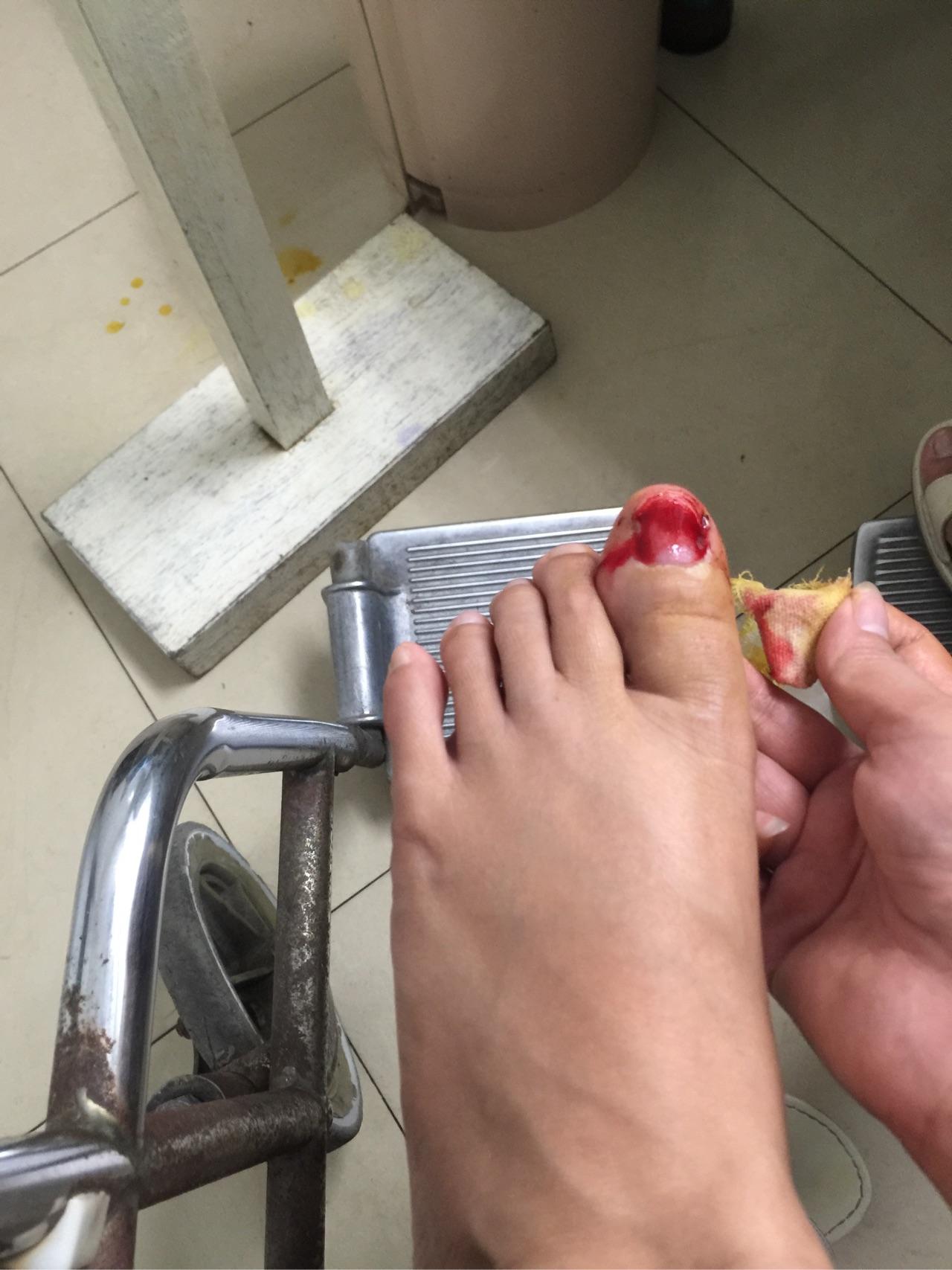 脚大拇指指甲被拔后,怎么让它好起来? - 知乎