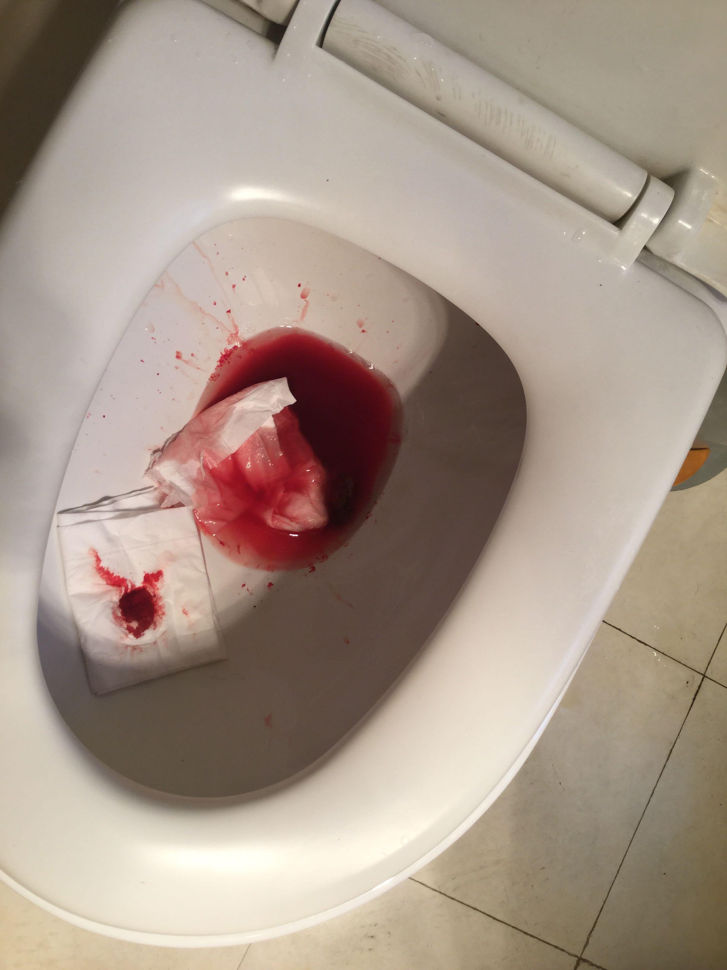 肛裂是种怎样的体验