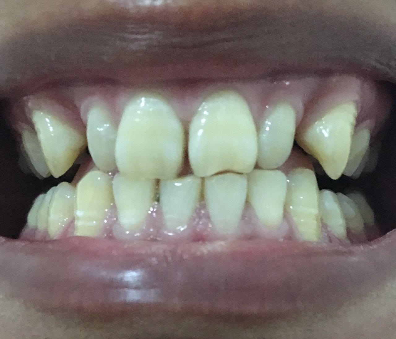 如何矫正虎牙? - 牙齿